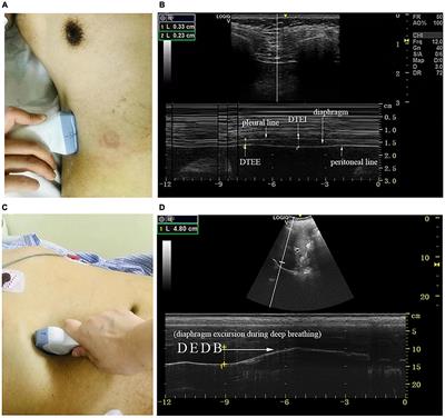 The Role of the Diaphragm in Postural Stability and Visceral Function in Parkinson’s Disease